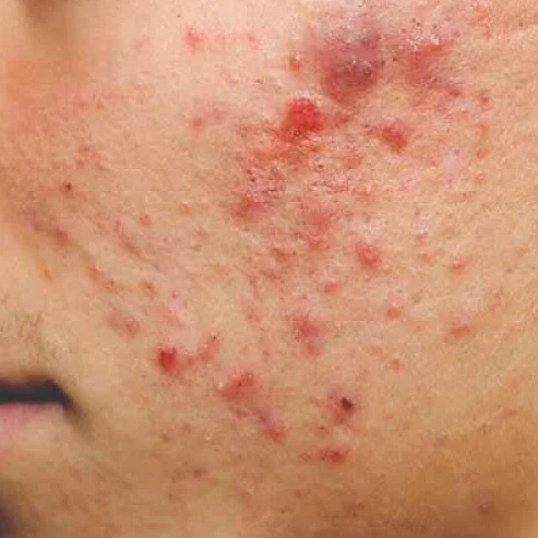 Acne