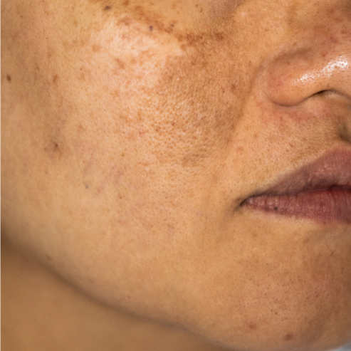 Dull Skin