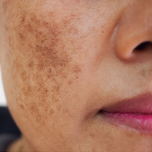 Freckles